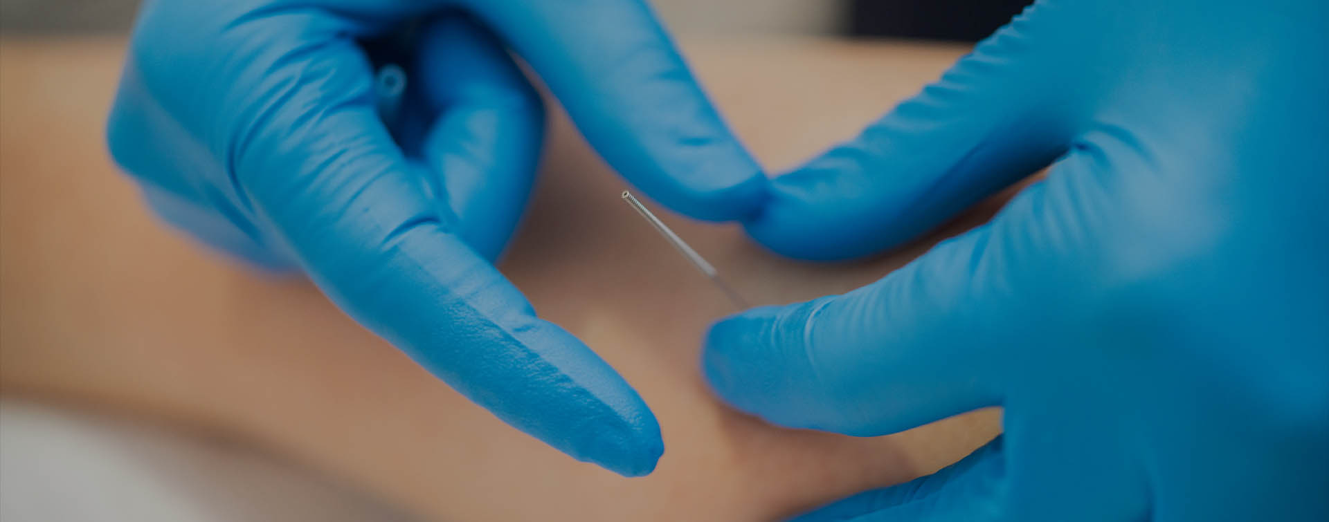 Dry Needling dry needling maitland